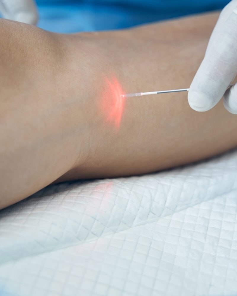 Endovenous,Laser,Treatment,Of,The,Leg,Vein,In,Hospital