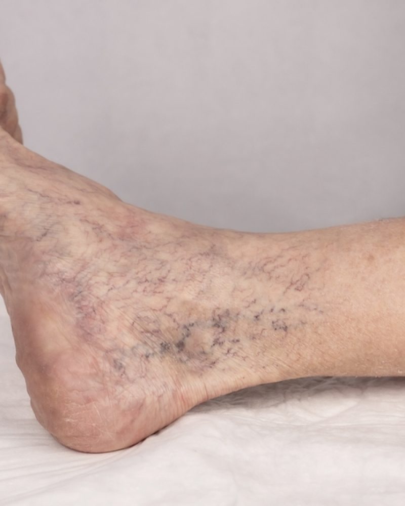 Varicose,Veins.,Spider,Veins,On,The,Legs,,Treatment,With,Sclerotherapy. Varicose,Veins.,Spider,Veins,On,The,Legs,,Treatment,With,Sclerotherapy.