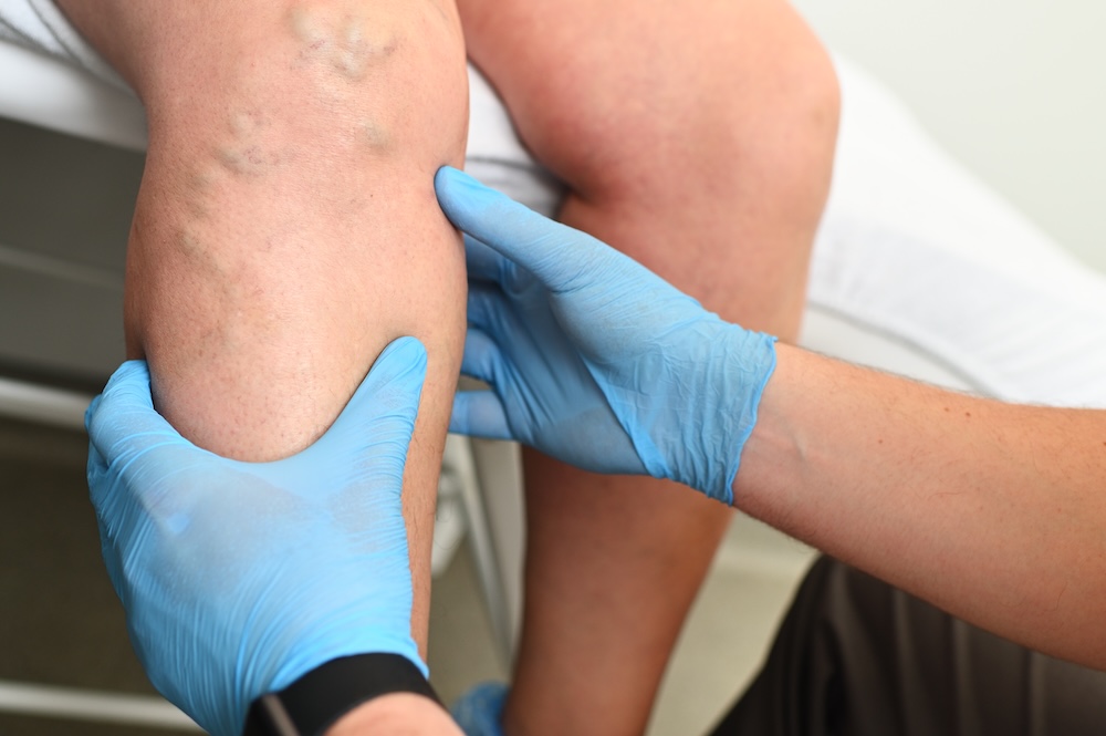 Hlebologist,Examines,A,Patient,With,Varicose,Veins,On,His,Leg. hlebologist examines a patient with varicose veins on his leg.