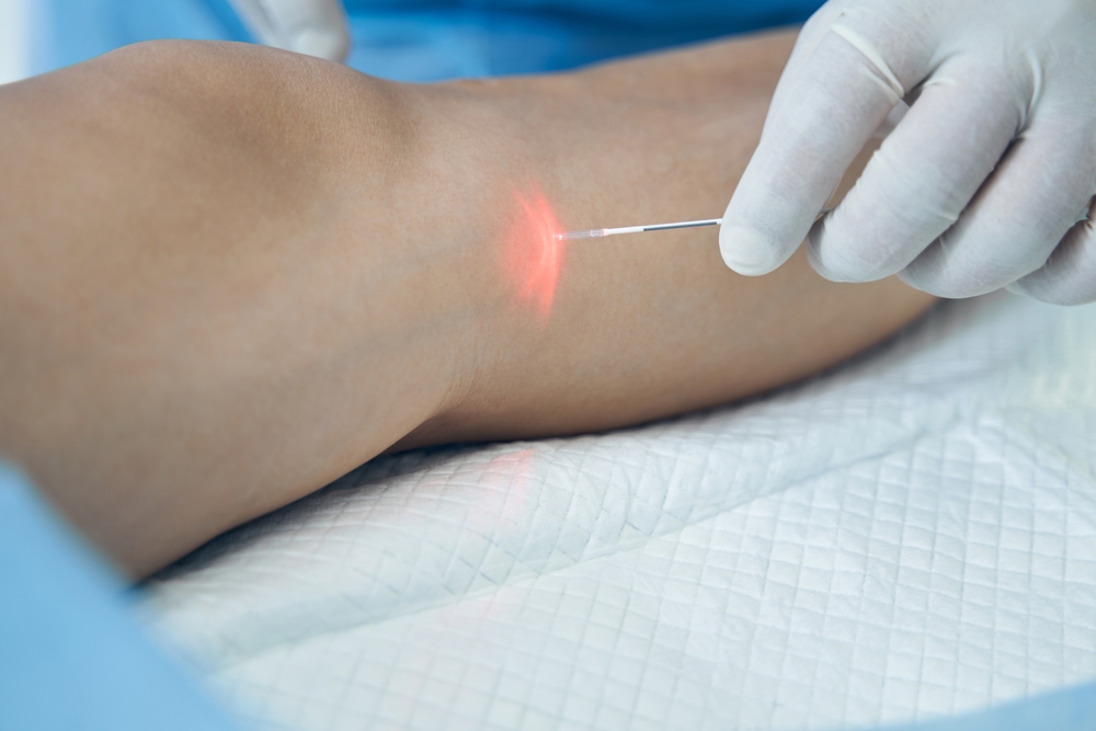 Endovenous,Laser,Treatment,Of,The,Leg,Vein,In,Hospital