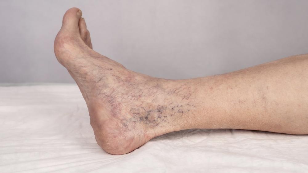 Varicose,Veins.,Spider,Veins,On,The,Legs,,Treatment,With,Sclerotherapy.