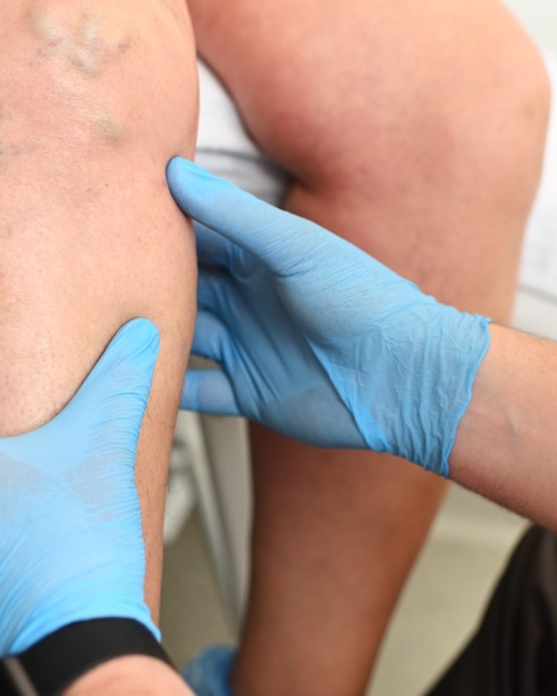 hlebologist examines a patient with varicose veins on his leg.